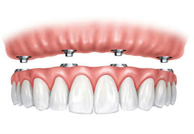 implant supported dentures model Atlanta GA