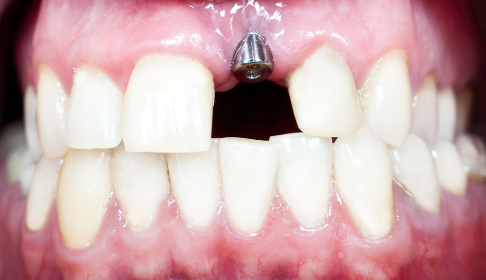 Get Dental Implants to Replace Missing Teeth Near Sandy Springs