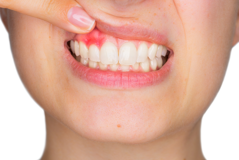 Risks of Gum Disease
