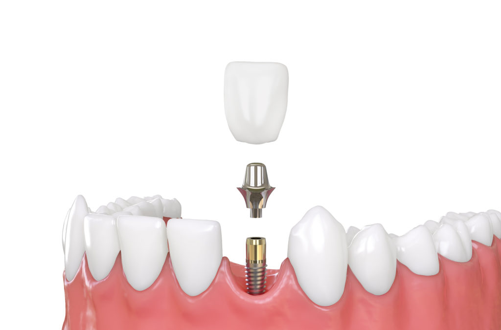 3d visual of getting dental implants in atlanta ga