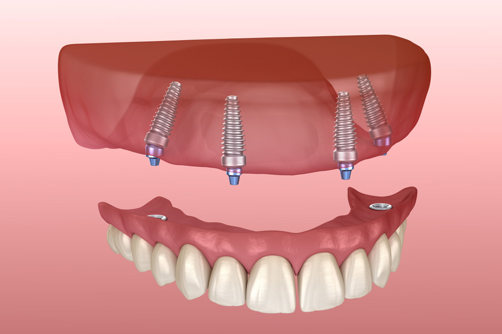 advantages and drawbacks of dental implants