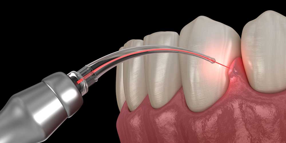 Gum Disease Treatment