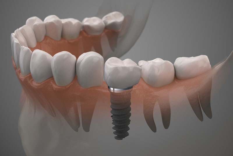 Dental Implants In Your Bone, Model