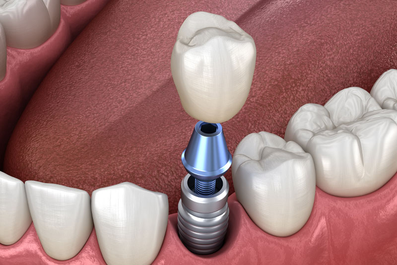 Dental Implants In Your Mouth