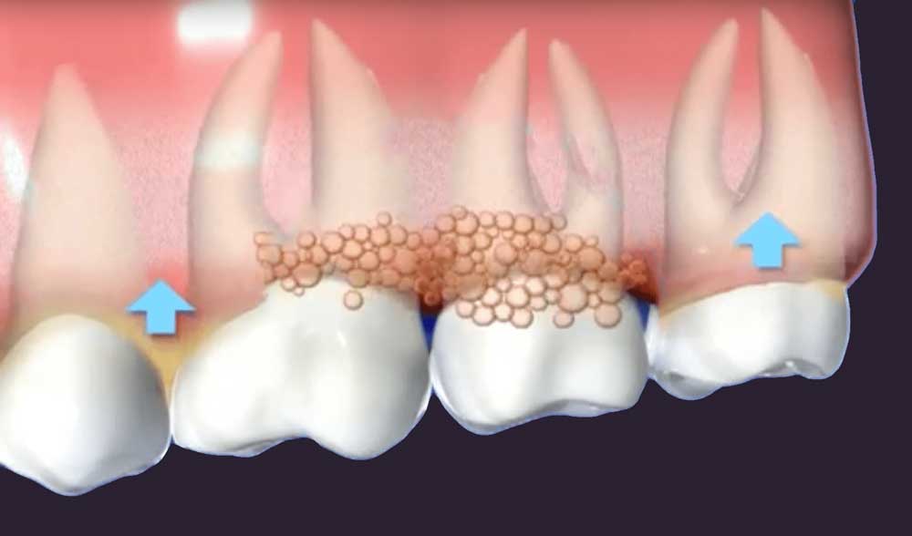 a diagram depicting gum affected by periodontal disease