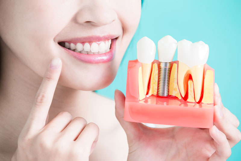 Patient Holding Dental Implant Model